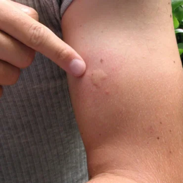 perché le zanzare pungono alcune persone